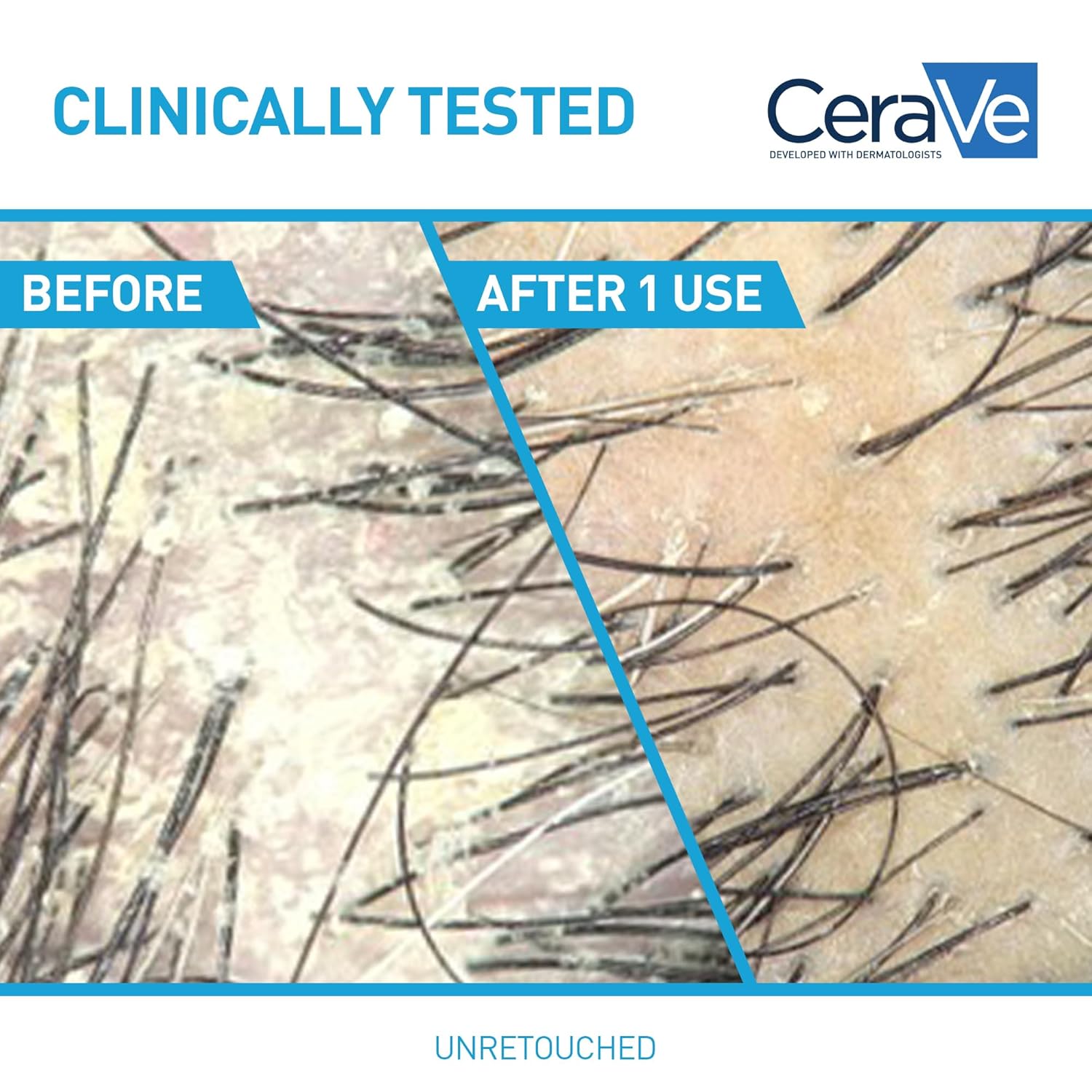 CeraVe Hydrating Anti Dandruff Shampoo and Conditioner Set, Pyrithione Zinc Dandruff Treatment With Ceramides, Hyaluronic Acid & Niacinamide, Helps Elimanate Flakes & Reduce Itchy Scalp
