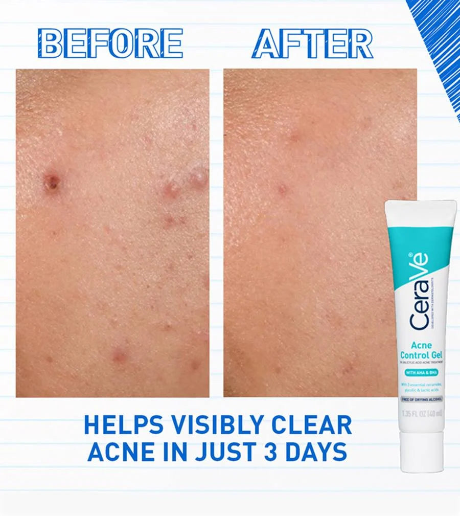 CeraVe Acne Control Gel, 2% Salicylic Acid Treatment With Glycolic Acid + Lactic Acids,